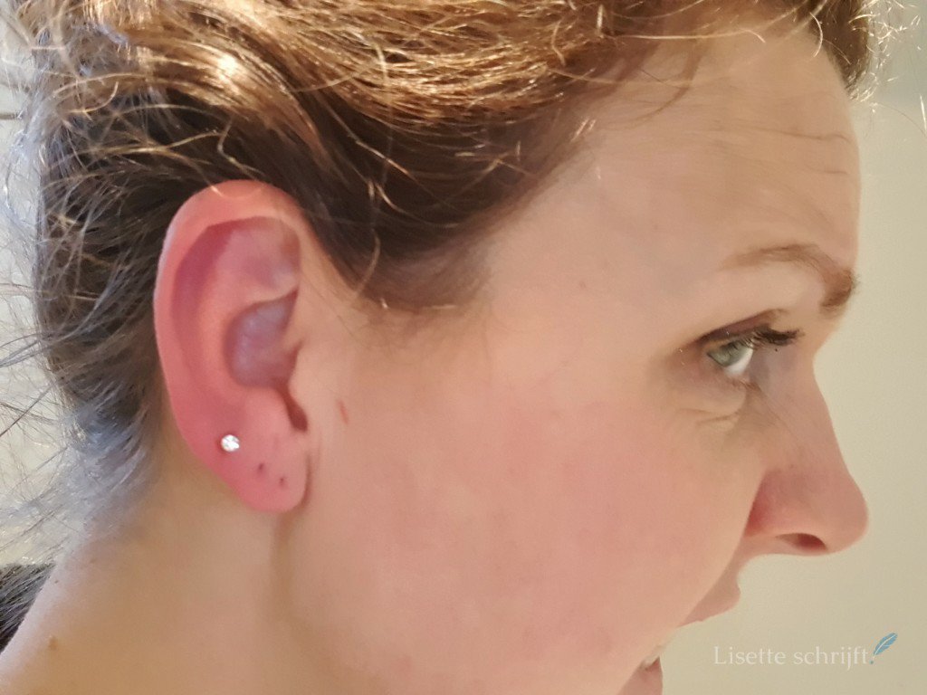 ontstoken oor door oorbellen die vastzitten
